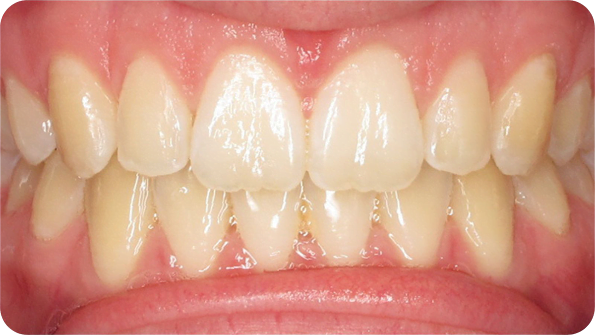 teeth after invisible braces