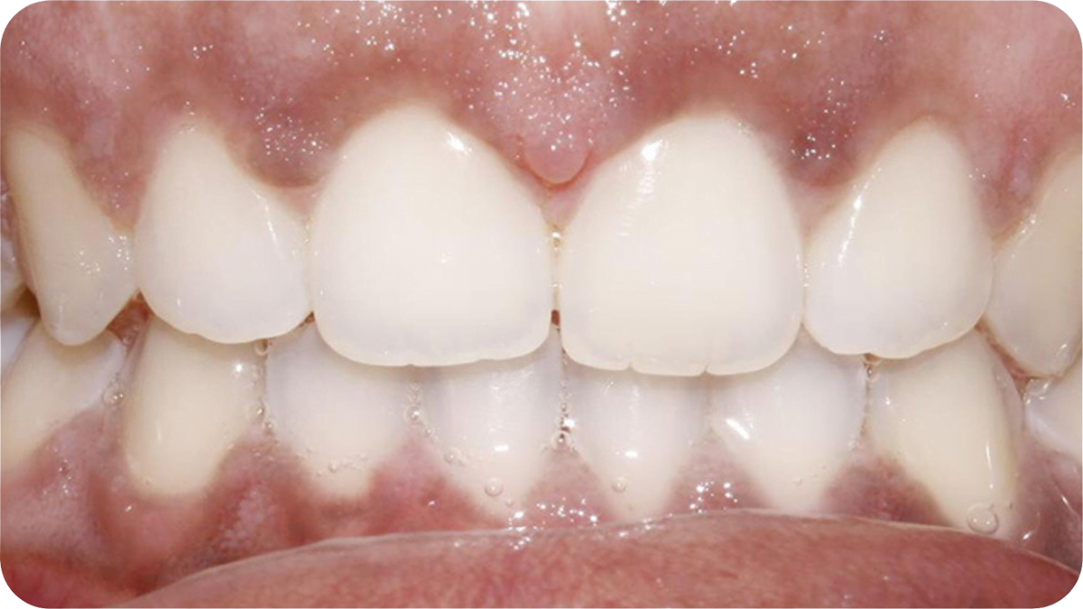 teeth after clear dental aligners