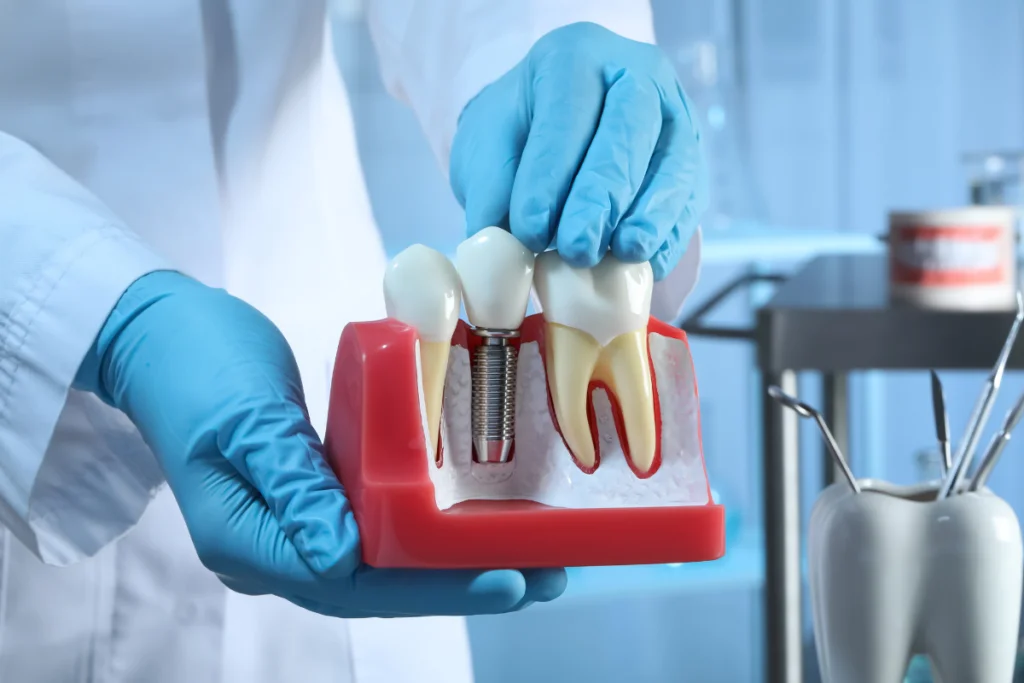 Dental Implants - Sacramento River Dental Group