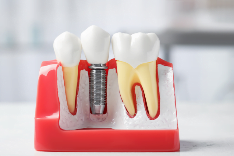Dental Implants: Enjoy Your Every Bite